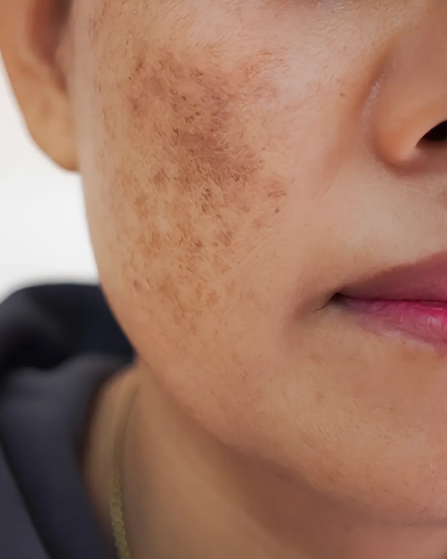 Melasma at Cinch Clinics